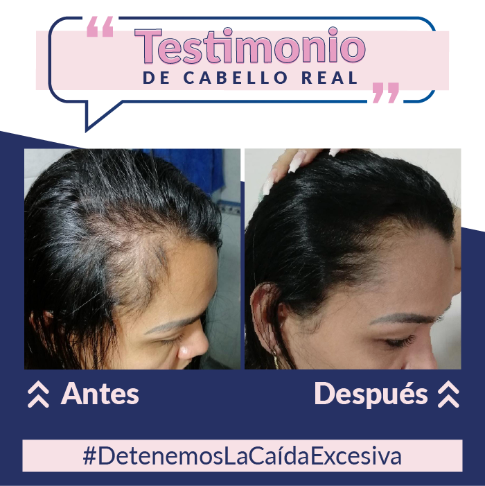 Vitaminas + Shampoo Anti-Caida + Loción capilar con minoxidil + Tratamiento nutritivo + Serum Termoprotector