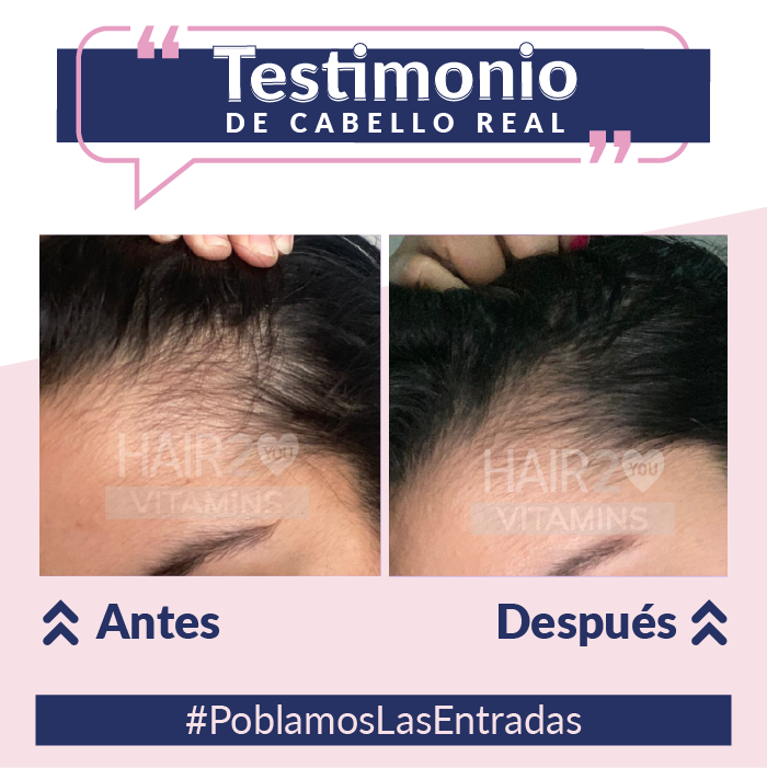 Vitaminas + Shampoo Anti-Caida + Loción capilar con minoxidil + Tratamiento nutritivo + Serum Termoprotector