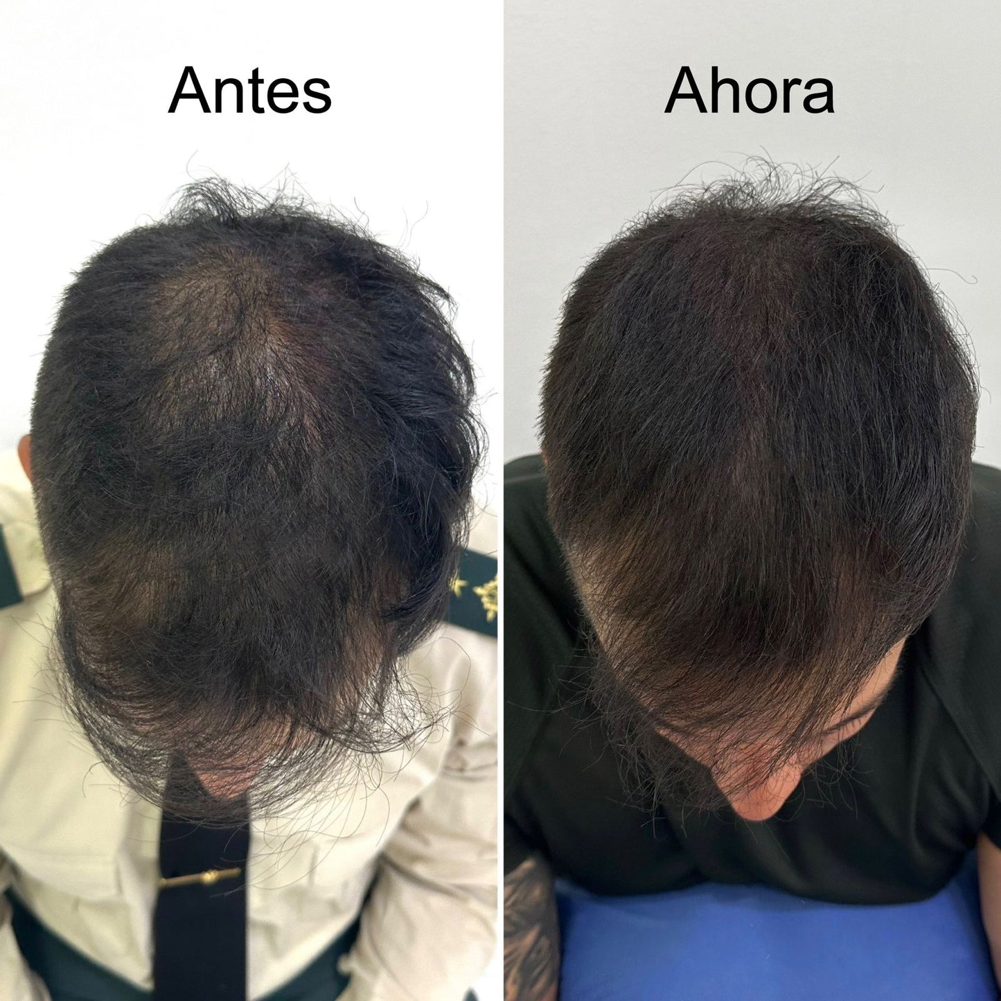 Rutina Anticaída Avanzada - Paga 2 y Lleva 3