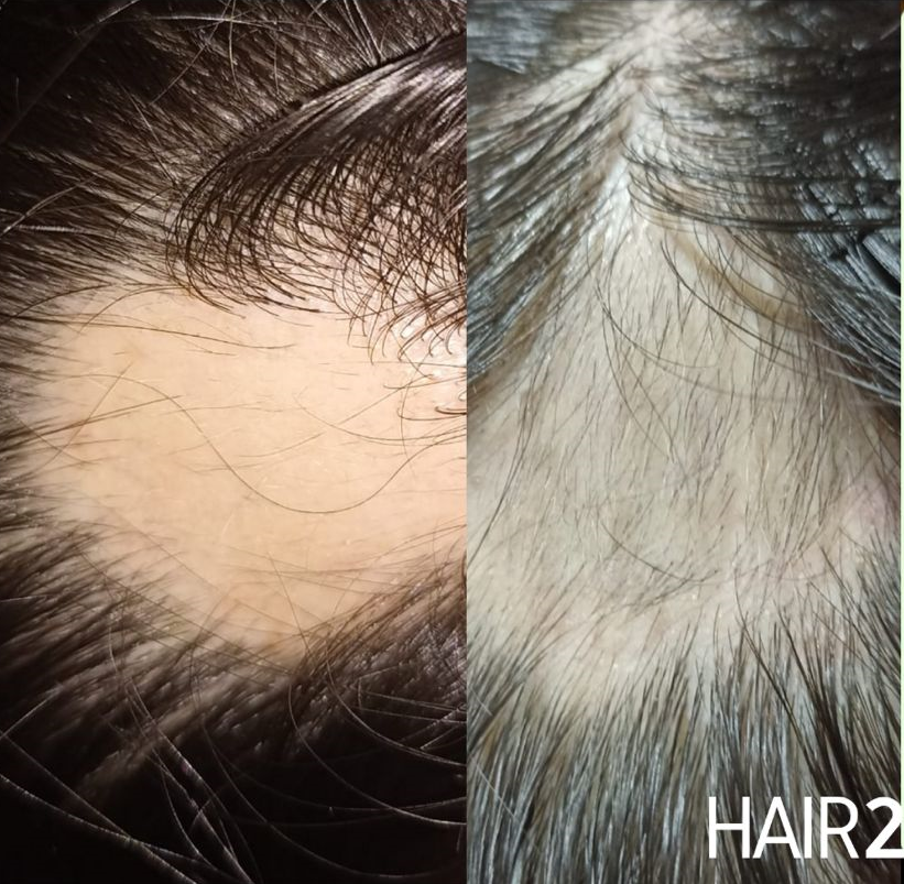 Membresía - Tratamiento Anticaída completo por 1 mes