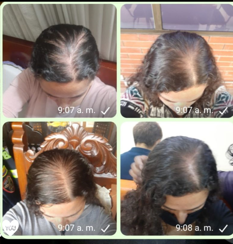 3 meses de Rutina Capilar Anticaída Intermedia